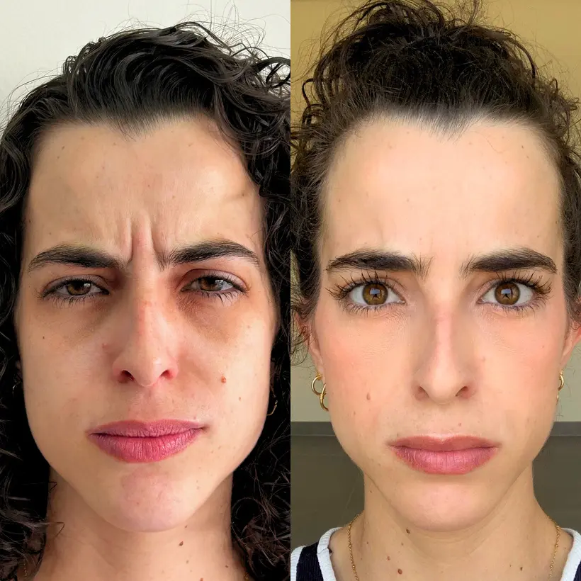 Resultado real relacionado à toxina botulínica