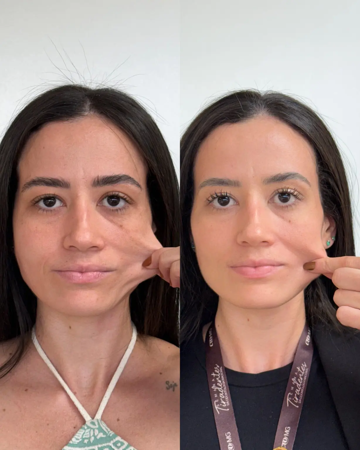 Resultado real relacionado a bioestimuladores de colágeno