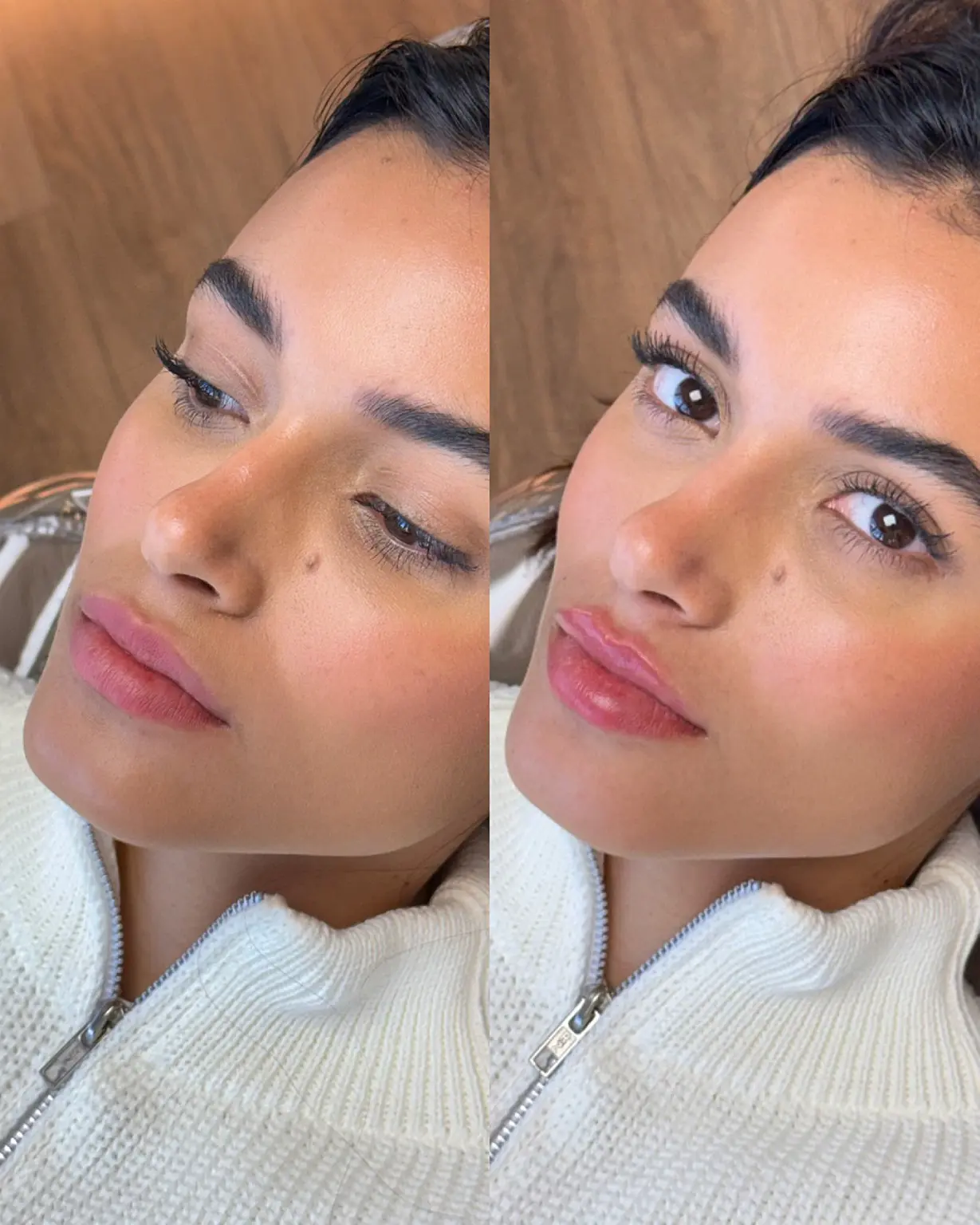 Resultado real relacionado a preenchimento facial